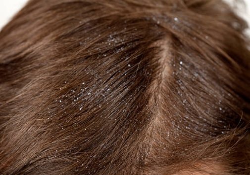 How to Get Rid of Dandruff